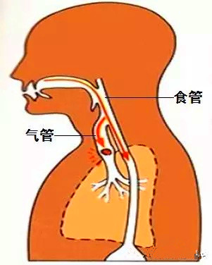 气管异物.jpg